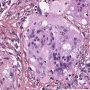 Nodal cryptococcosis (Cryptococcus neoformans)