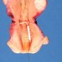 Uterus with coil and parietal leiomyoma