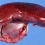 Normal spleen (splenectomy for thrombocytopenia)