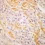 Granuloma annulare