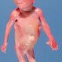 Microcephaly, fetal immotility sequence
