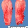 Normal uterus