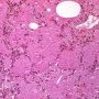 Adult alveolar proteinosis