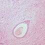 Invasive lobular carcinoma of the breast (Credit Ed Uthman)