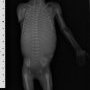 Humeral meromelia (fetus, 21 weeks)