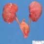 Nephromegaly without renal dysplasia