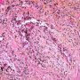Bronchiolitis obliterans after bone marrow allograft