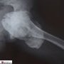 Tumoral calcinosis