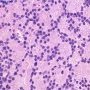 Gleason Pattern 4 (WebPathology)