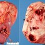 Extracapsular invasion of perirenal fat in massive Wilms tumor