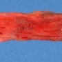 Hemorrhagic oesophageal hemorrhages