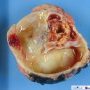 VHL-associated cystic renal cell carcinoma