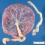 Normal placenta