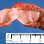 Mediastinal esophageal duplication cyst (primitive foregut cyst)