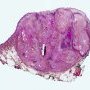 Pilomatrixoma