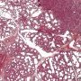 Acute bronchopneumonia