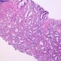 Gleason Pattern 3 (WebPathology)