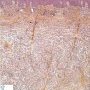 Plexiform fibrohistiocytic tumor