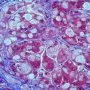 Polyglycosan inclusions in glycogen storage disease type 4 (GSD4)