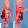 Short umbilical cord with thoracoabdominal schisis