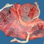 Triple pregnancy placenta