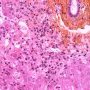 Autoimmune hepatitis