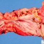 Colonic stenosis in Crohn disease