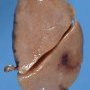 Extralobar pulmonary sequestration