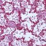 Acute pneumonia in bacterial pneumonia