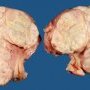 Uterine leiomyosarcoma
