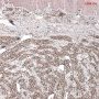 Plexiform fibrohistiocytic tumor