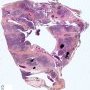 Thymic cyst