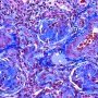WT1-associated diffuse mesangial sclerosis