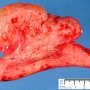 Intestinal lymphangioma
