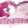 Colonic pneumatosis in cystic fibrosis