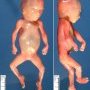 Tringular face in ring chromosome 15