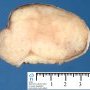 Mammary fibroadenoma