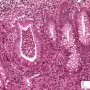 Cryptic abcess in colonic Crohn disease.