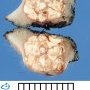 Pilomatricoma