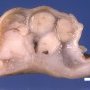 Gatsric GIST