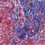 Portal fibrosis and biliary ductular proliferation in juvenile (...)