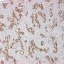 Juvenile angiofibroma (smooth muscle actin)