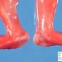 Rocker-bottom feet