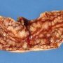 Crohn ileitis