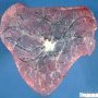 Triangular placenta