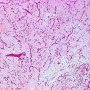 Myxoid liposarcoma