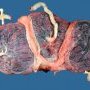 Triple pregnancy placenta
