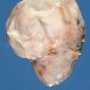Fetal hydronephrosis with polar cystic dilatation