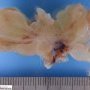 Botryoid embryonal rhabdomyosarcoma of the nasopharynx