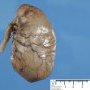 colonic atresia